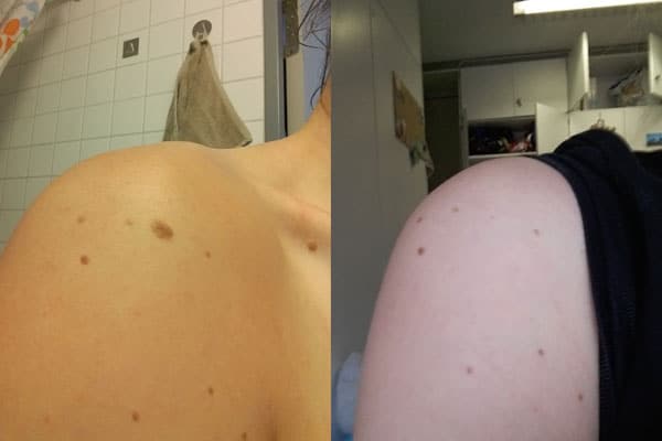 Mole removed from shoulder