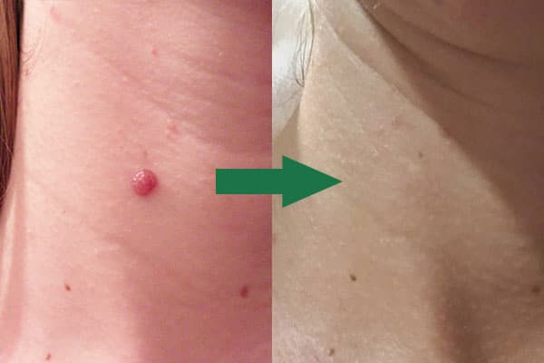 Raised mole removal from the neck