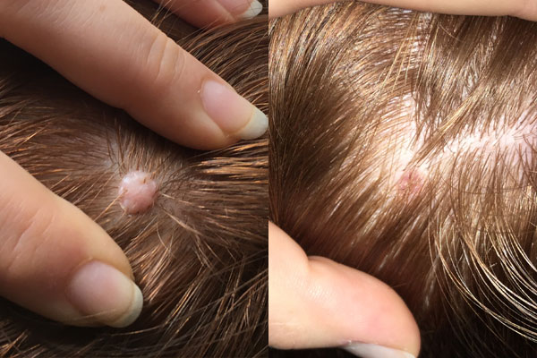 Pink mole removed from the scalp