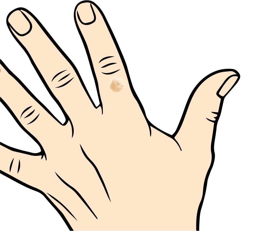 behandlung-zur-entfernung-von-handwarzen-mit-lealea-creme-lealea